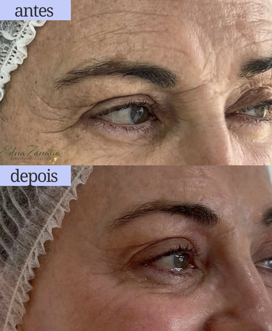 Antes e depois do Caso da Rosane com Peeling de Retração New Skin