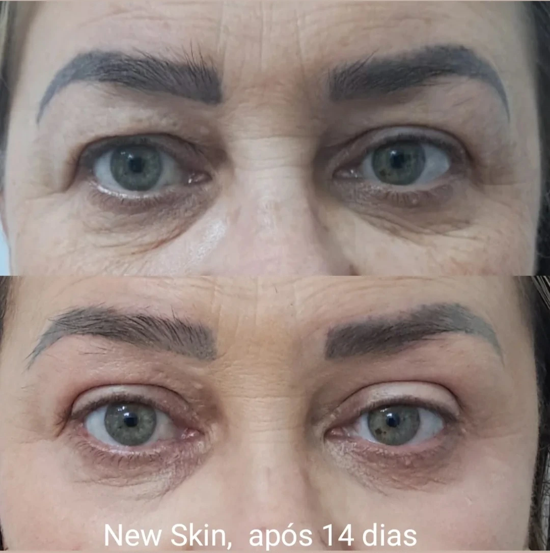 Antes e depois do sétimo resultado com Peeling de Retração